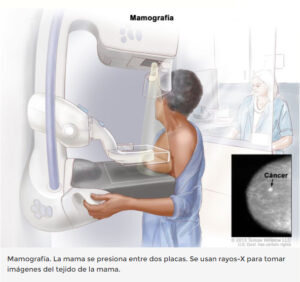 cancer de mama